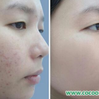 CAO TINH NGHỆ/CAO KHỔ QUA COCOON