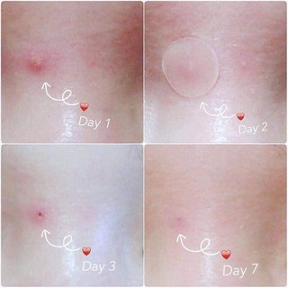 Miếng dán mụn Cosrx Clear Fit Master Patch / Cosrx Acne Pimple Master Patch