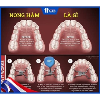 [BÁN CHẠY] Khí cụ nong hàm chỉnh nha Expansion Screw