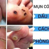 Serum Nunamin - chuyên mụn cóc , mắt cá , chai sừng