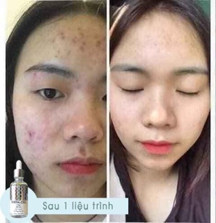 Serum tinh chất tế bào gốc