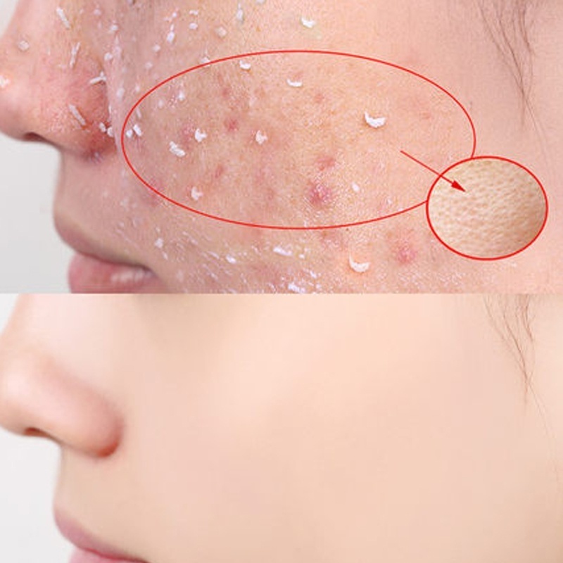 Gel Tẩy Tế Bào Chết 30g Chứa Hyaluronic Acid Giúp Dưỡng Ẩm Và Chống Lão Hóa Hiệu Quả