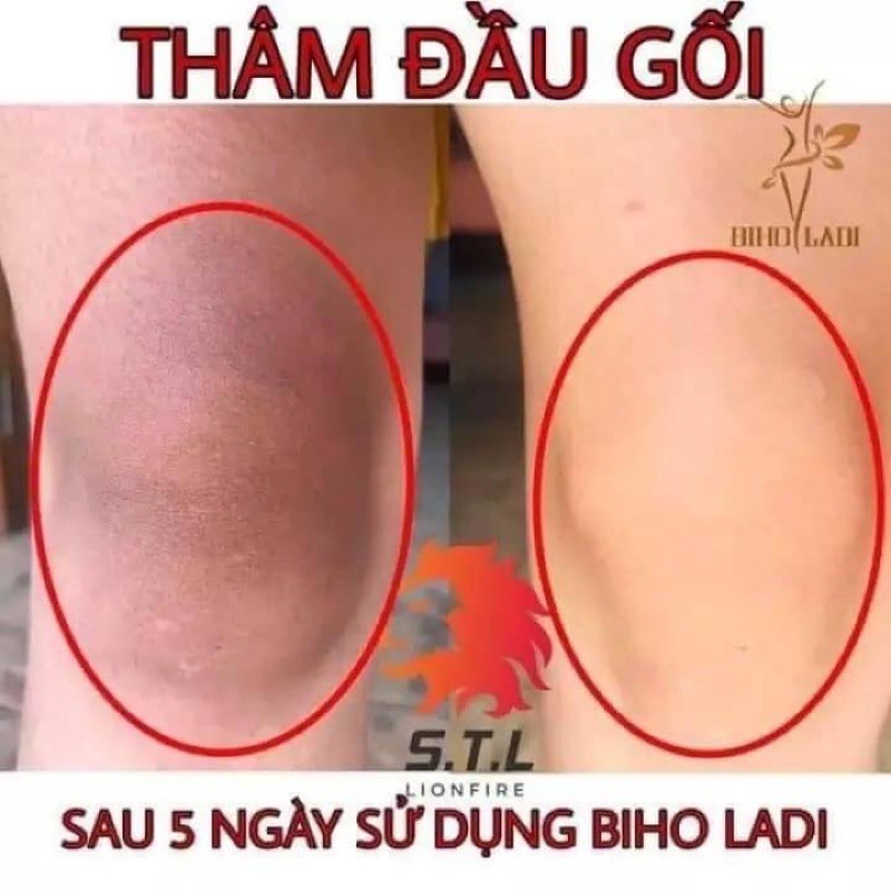 [CHÍNH HÃNG] KEM MỜ THÂM 5S BIHOLADI | BigBuy360 - bigbuy360.vn