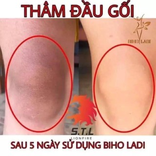 [CHÍNH HÃNG] KEM MỜ THÂM 5S BIHOLADI