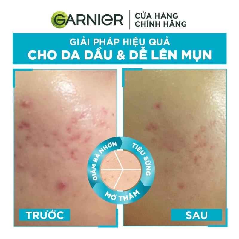 Tinh Chất Garnier Giảm Mụn Mờ Thâm Cho Da Dầu, Mụn 30ml