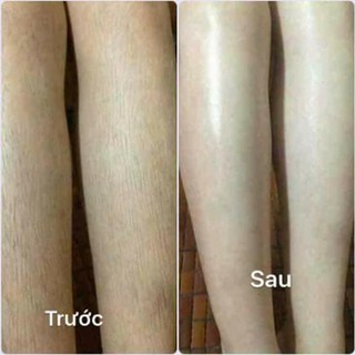 WAS  LÔNG REMOVE VEO VÀ MỠ TRĂN TRIỆT LÔNG VĨNH VIỄN