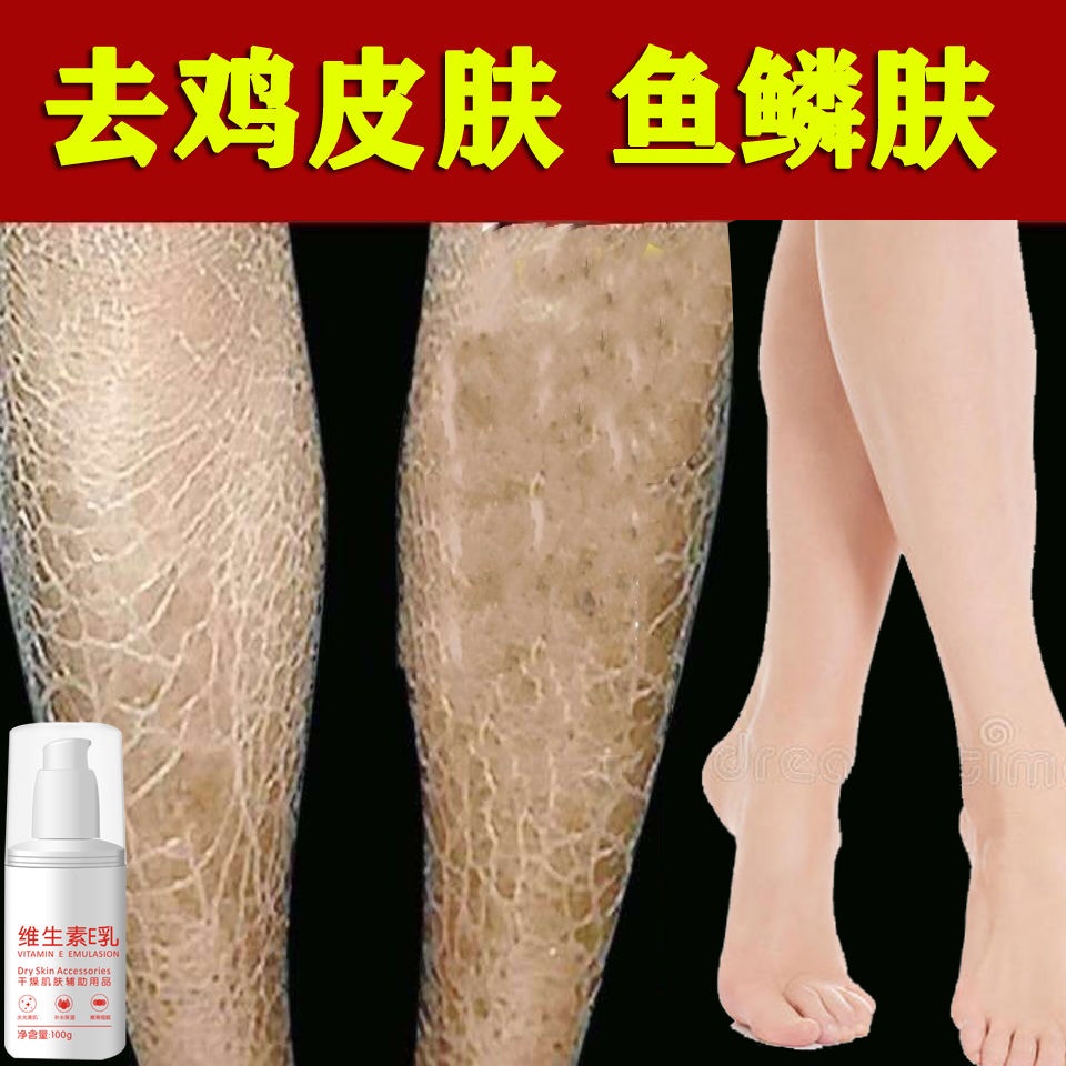 Kem vitamin E dưỡng ẩm hỗ trợ giảm mụn thịt da gà/ da rắn khô hiệu qu