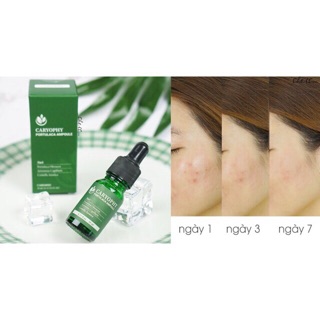 Tinh Chất Giảm Mụn Caryophy Ampoule 10ml Nhập Khẩu Chính Hãng