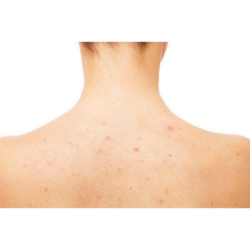 LOTION KELLA VIÊM LỖ CHÂN LÔNG,  VIEM DA THÁI LAN