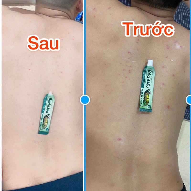 Kem bôi da thảo dược Bách Liễu