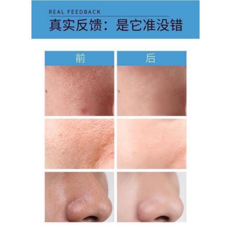 Bộ 2 sản phẩm dưỡng trắng se khít lỗ chân lông gồm gel nha đam và serum se khít lỗ chân lông zhenxiu