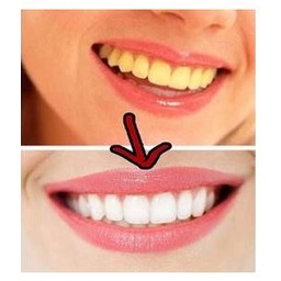 [Có Tem Nhãn] Kem Đánh Răng Làm Trắng Răng Và Ngăn Ngừa Vết Ố White Glo 150G Chính Hãng