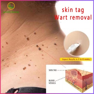 (Hàng Mới Về) Thuốc Mỡ Trị Mụn Cóc Dung Tích 10ml