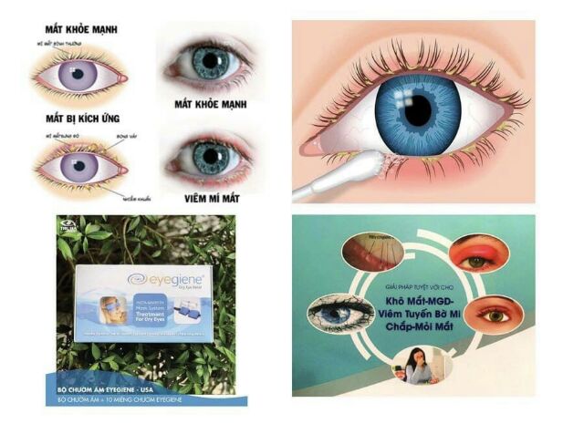 BĂNG và MIẾNG CHƯỜM ẤM MẮT EYEGIENE - Hỗ trợ giảm thâm mắt, che mắt giảm căng thẳng, khô mắt, đau mắt, lẹo, mỏi mắt,bịt
