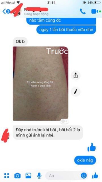 Viêm nang lông | BigBuy360 - bigbuy360.vn