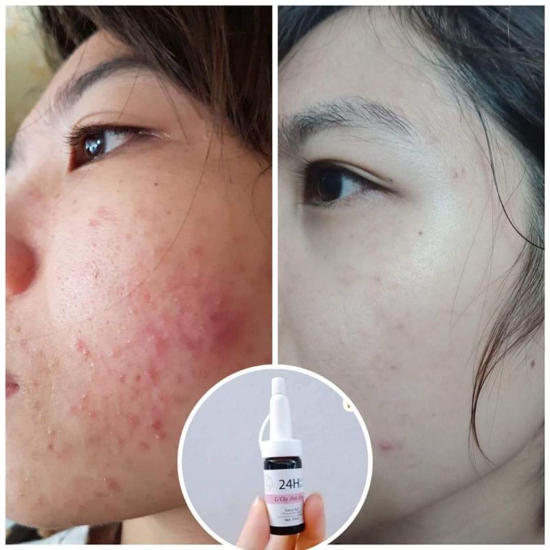 SERUM MỤN 24H LI'CHY [GÔM CÙI MỤN NHANH ]