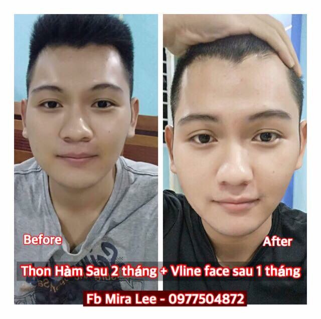 Tinh Chất Thu Xương Vline Face Hàn Quốc