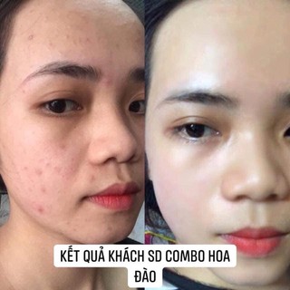 [ Chính Hãng] Combo kem mụn nắp đen vs serum Hoa Đào