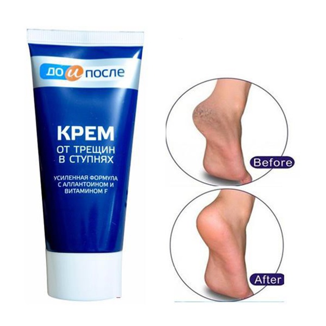 Kem Ngăn Ngừa Và Hồi Phục Nứt Nẻ Gót Chân Kpem Nga 50ml