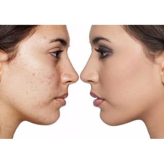 KEM NỀN TƯƠI NEUTROGEN