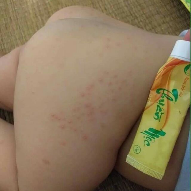 Mùa của nước ăn chân Mùa của ghẻ lở hắc lào.Và đặc biệt các mẹ có con nhỏ hay bị hăm tã.Dùng ngay thuốc da liễu nhé
