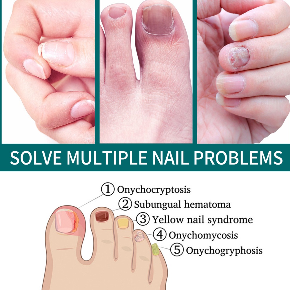 ♕Nam Trung Thu Móng Chân Sửa Chữa Chất Lỏng Onychomycosis Tay Và Chân Móng Tay Va Sửa Chữa Chất Lỏng Mịn Móng Dày Mềm Mại Móng Tay Chăm Sóc Móng Tay