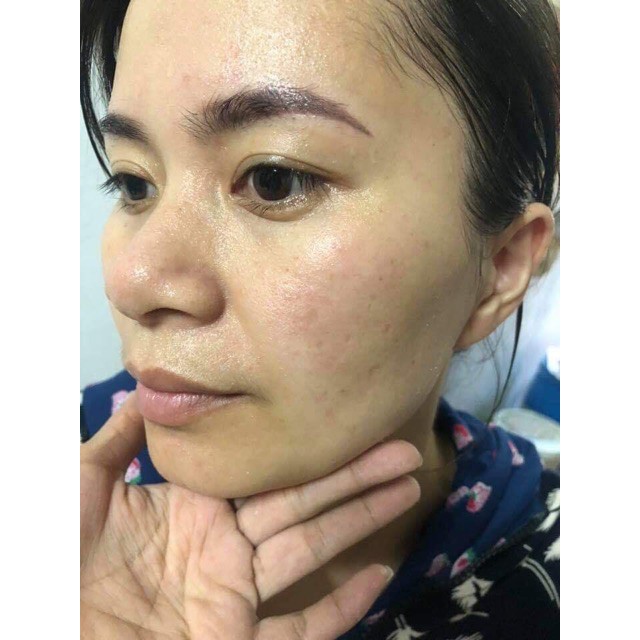 Kem hút nám tàn nhang ol cell . | BigBuy360 - bigbuy360.vn