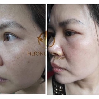 Bộ Đôi Phá Nám gấp 2 lần - SUPER MELASMA PRO