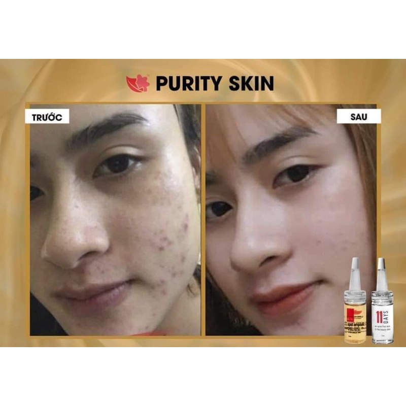 [CHÍNH HÃNG] BỘ GIẢM MỤN, NGỪA MỤN PURITY SKIN mua kèm Nước Tẩy Trang | BigBuy360 - bigbuy360.vn