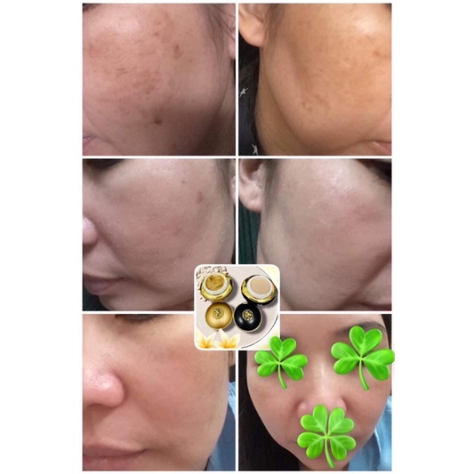 TÁI TẠO ĐÔNG Y L2 ĐEN MẠNH/ VÀNG NHẸ   Dành cho da NÁM-Lỗ chân lông to-Căng bóng da