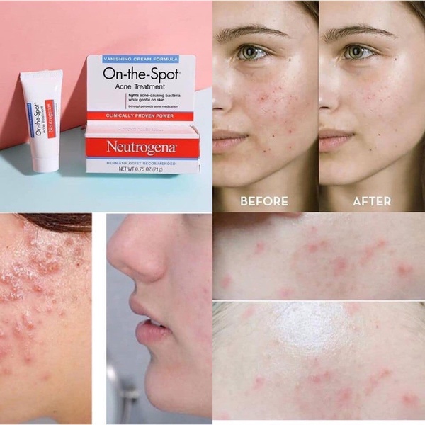 Kem chấm mụn Neutrogena On The Spot Acne Treatment ( 21g )