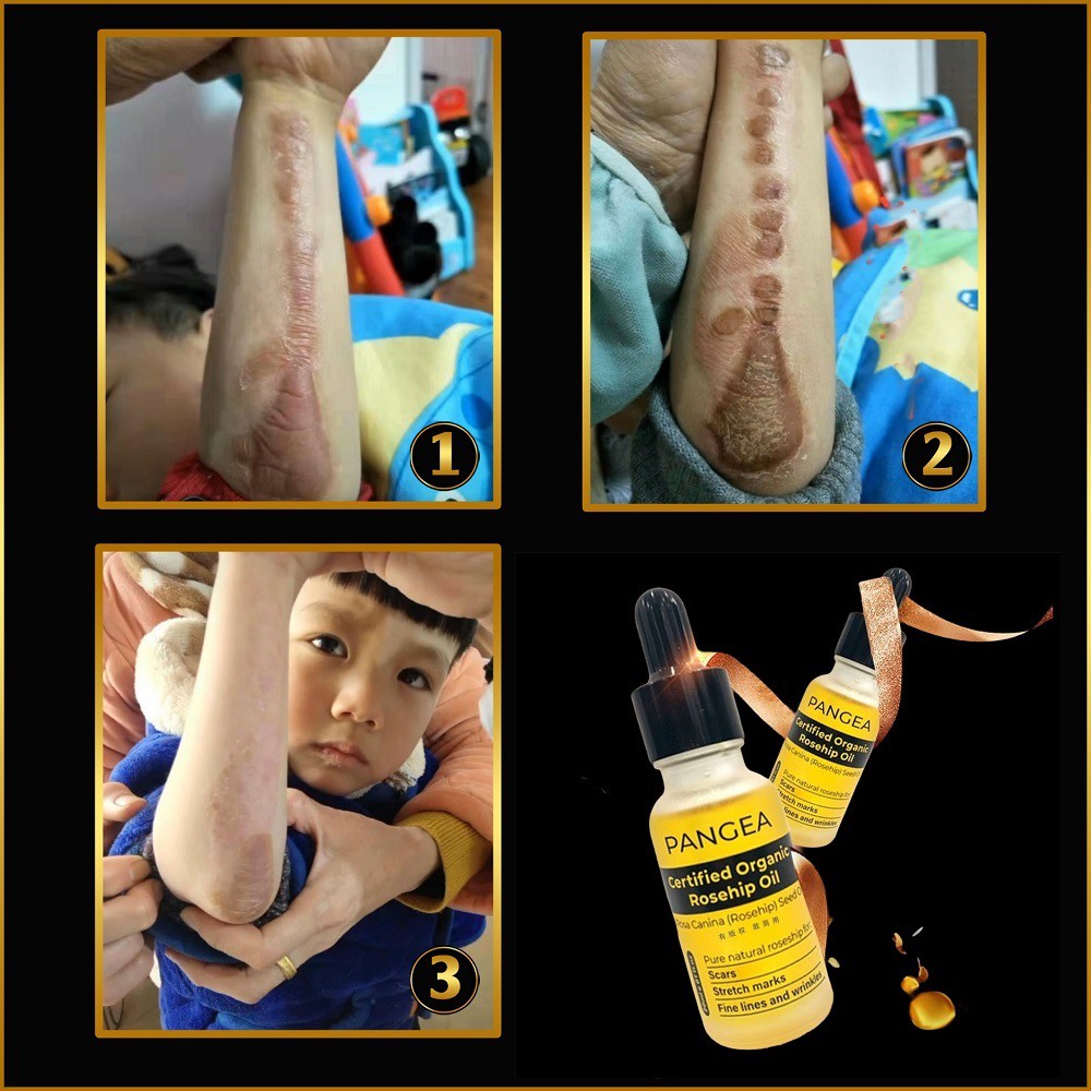 Serum Xóa Sẹo Lồi - Sẹo Lõm - Sẹo Rỗ Lâu Năm PANGEA 20ml