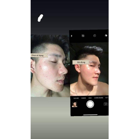 [Freeship] Dược chấm mụn dr acne Hải Âu Việt-Sạch Mụn-Không Sưng Đỏ