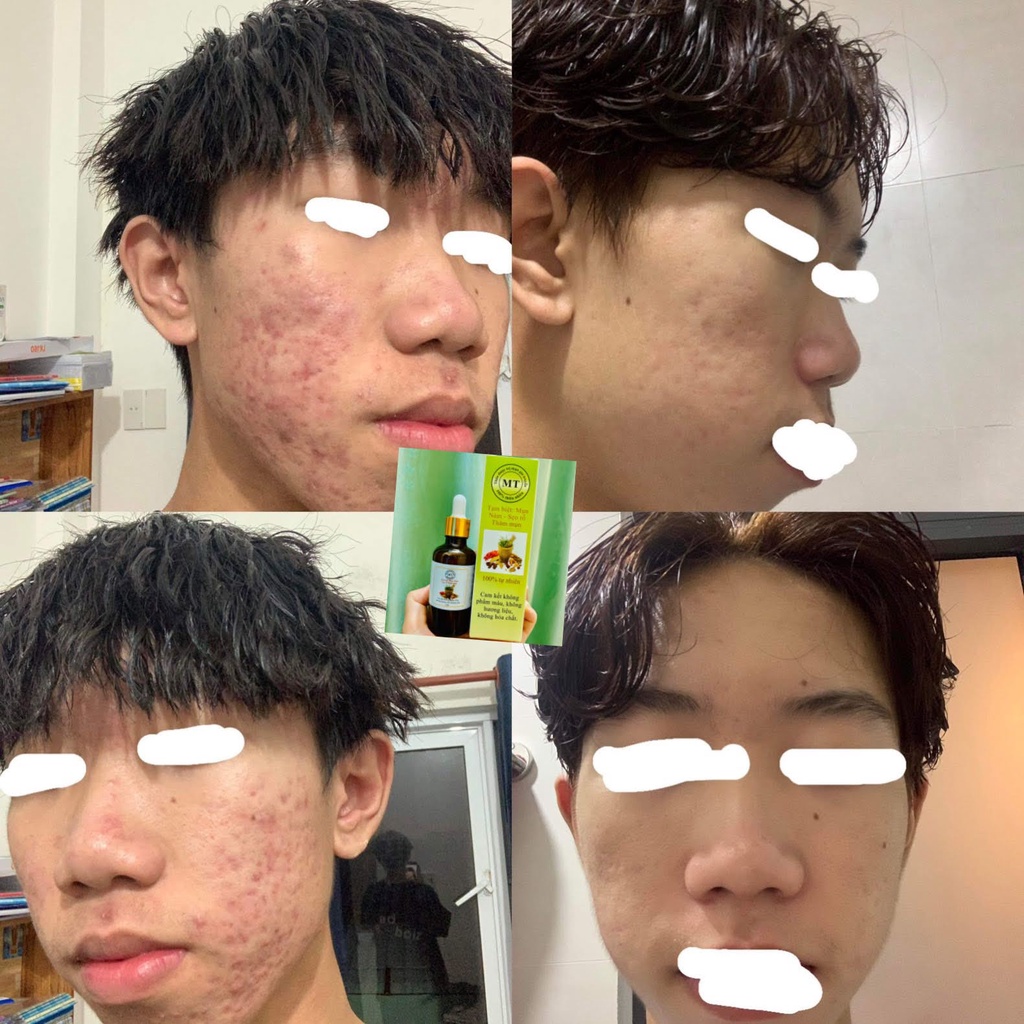 Thảo Dược Giảm Mụn Thâm Rỗ MT | BigBuy360 - bigbuy360.vn