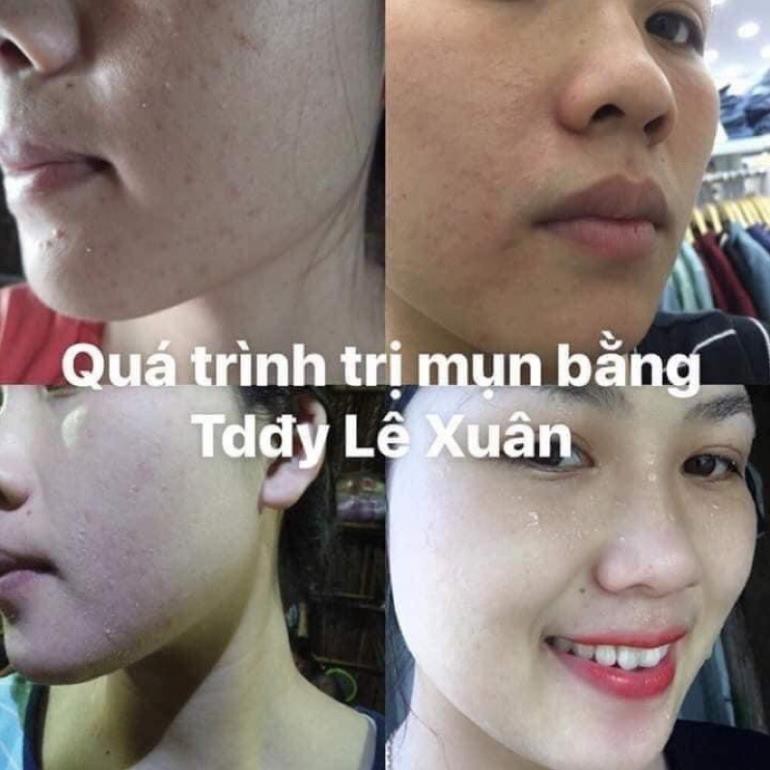 Tinh chất mụn Lê Xuân handmade 130ml | BigBuy360 - bigbuy360.vn
