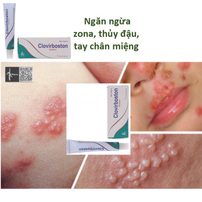 Kem bôi THUYDAU ZONA✅ ngăn ngừa viêm da, mụn rộp, zona, thủy đậu, tay chân miệng