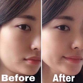 Tạo hình Vline ko cần phẫu thuật