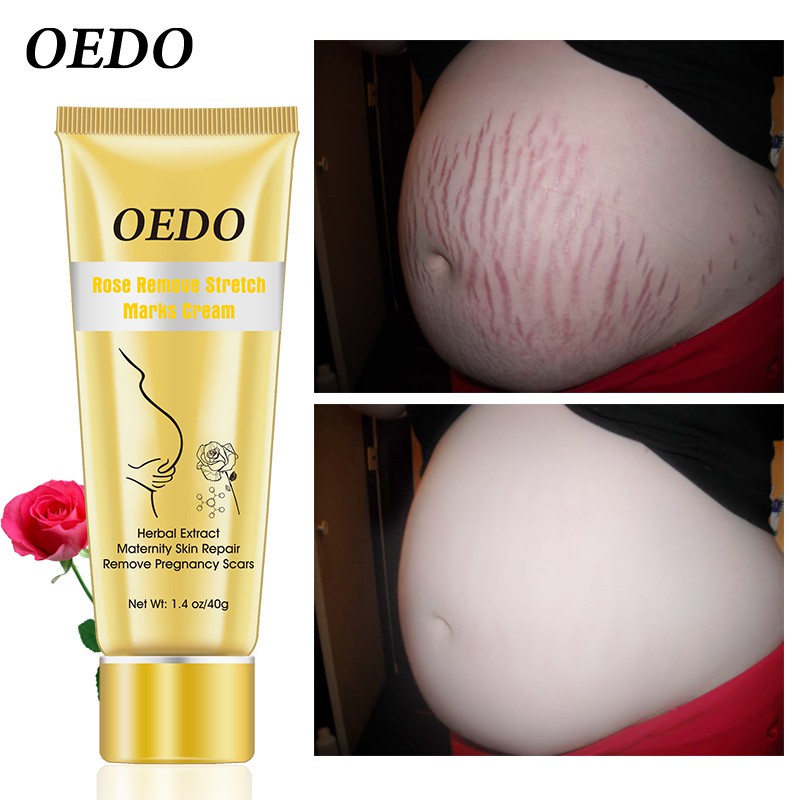 OEDO Rose Remove Stretch Marks Cream 40g | BigBuy360 - bigbuy360.vn