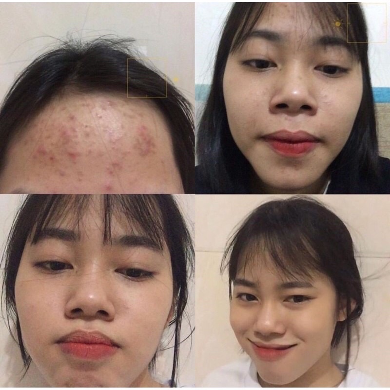 TURMERIC EXTRACT - KEM HỖ TRỢ ĐÁNH BAY CÁC LOẠI MỤN 20g