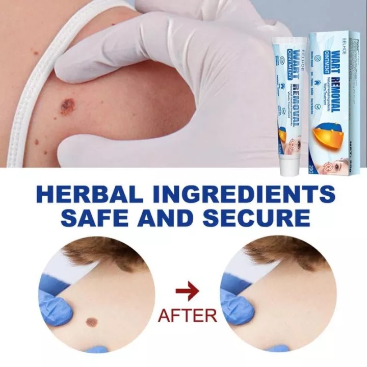 Serum gel tẩy nốt ruồi xóa mụn ruồi trên mặt, tàn nhang, mụn cóc, mụn thịt , mụn cơm, mắt cá tại nhà an toàn và gel mờ s
