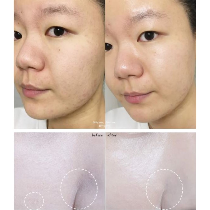 Tinh Chất Tẩy Da Chết Hóa Học So' Natural Red Peel Tingle Serum 35ml | BigBuy360 - bigbuy360.vn