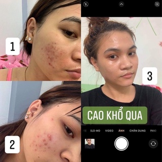[SOHERBS] 𝐆𝐄𝐋 𝐑Ử𝐀 𝐌Ặ𝐓 𝐊𝐇Ổ 𝐐𝐔𝐀 + 𝐂𝐀𝐎 𝐊𝐇Ổ 𝐐𝐔𝐀 combo cho làn da MỤN 🥒