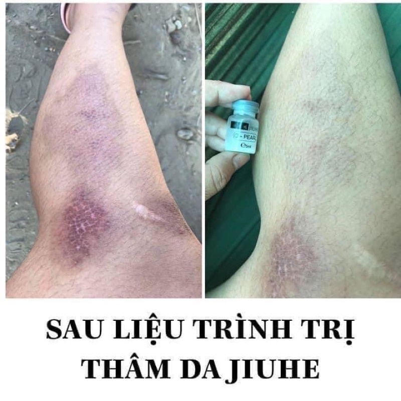 [HÀNG CHÍNH HÃNG] Serum Jiuhe xoá mờ thâm mụn, thâm các vùng cánh, mông, sẹo, nám - Loại bỏ những vết thâm lâu năm