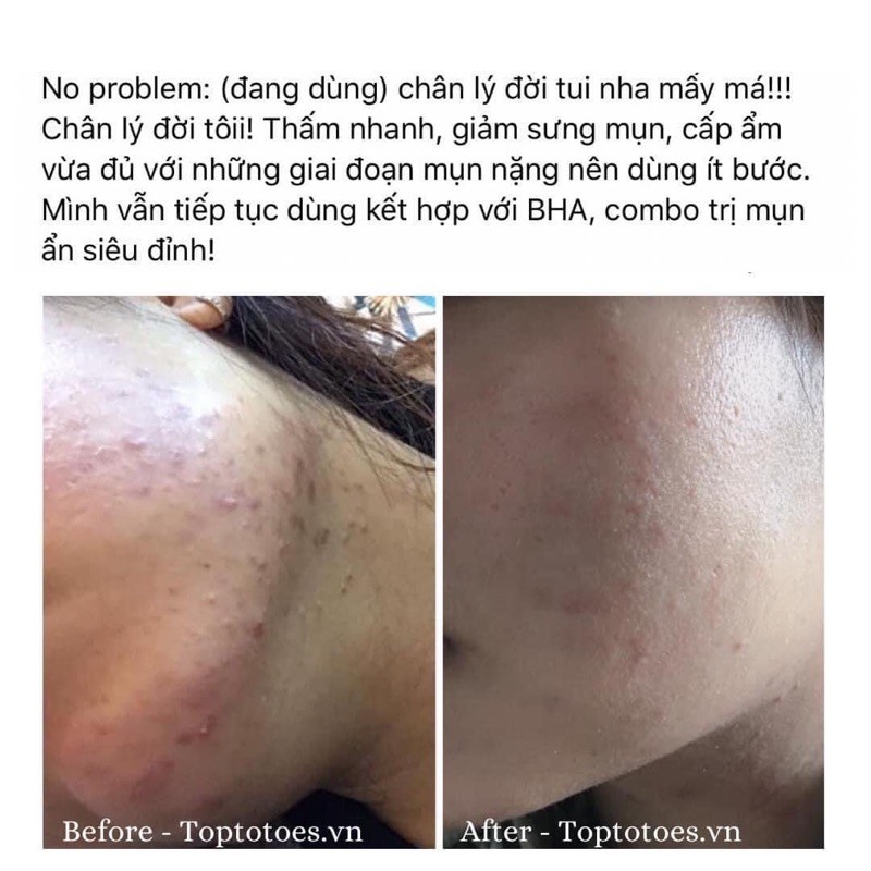 Serum Teana Super Peptides No Problem Intensive Care giảm sưng, đẩy & gom cồi mụn giảm tiết dầu