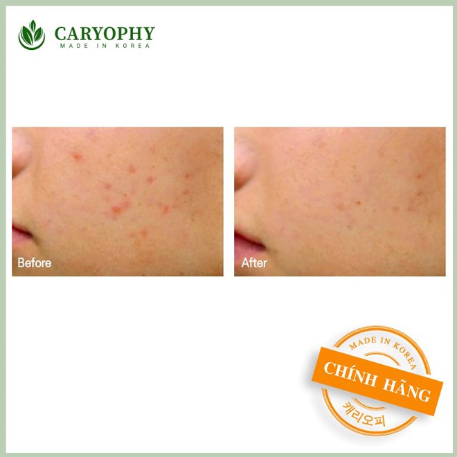 Nước Hoa Hồng Cho Da Mụn CARYOPHY Portulaca Toner 300ml