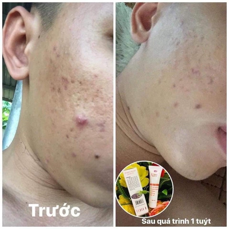 Cam Kết Hàng Chuẩn Kem mụn Opera Australia Anti Acnes