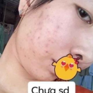 Kem face mụn huỳnh đỗ