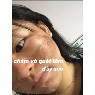 PEEL TCA USA CHẤM SEO THAM NAM DOI MOI