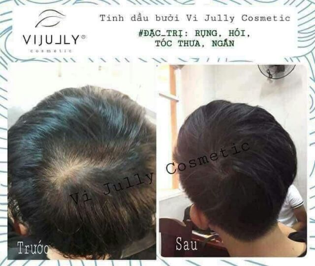 [Tặng Ví Nữ] Tinh Dầu Bưởi KÍCH THÍCH MỌC TÓC Vi Jully  -  Hạn Chế Rụng Tóc - Giúp Tóc Chắc Khỏe n | BigBuy360 - bigbuy360.vn