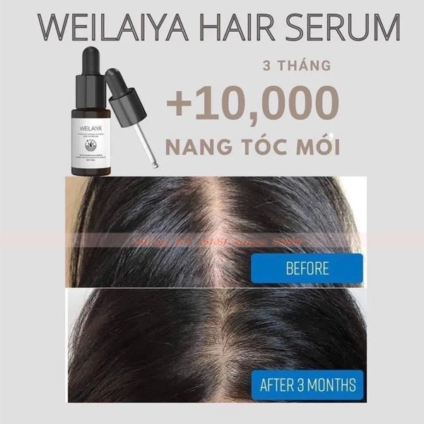 Tinh Chất Kích Thích Mọc Tóc - Ginger Hair Root Nourishing Essence 5ml x8